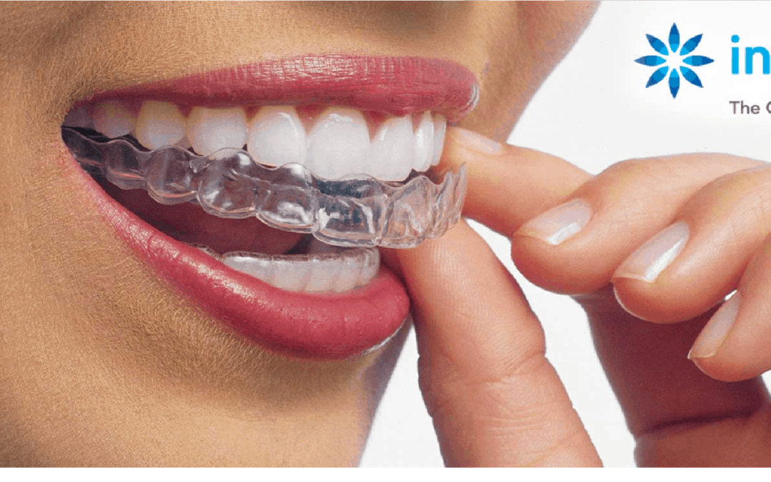 Direct-to-Consumer Clear Aligners | 9 REASONS TO AVOID THEM