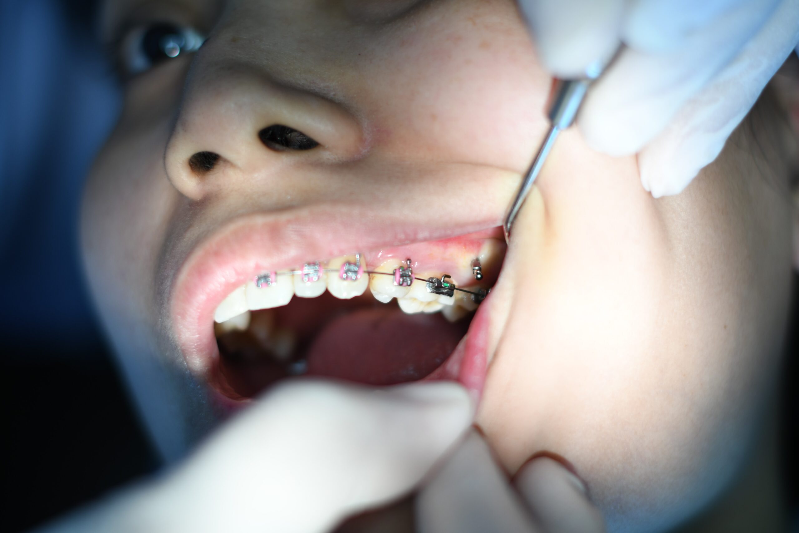 Braces with Missing Teeth (IS IT POSSIBLE?)