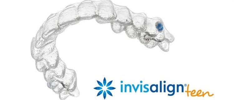 Invisalign Teen (5 REASONS WHY YOU SHOULD CONSIDER IT)