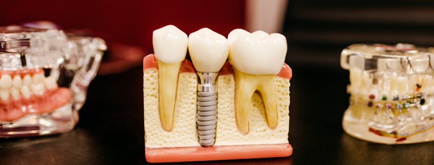 Braces with Root Canal or Crowns